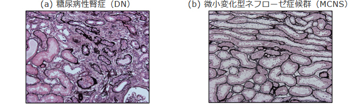 糖尿病性腎症（DN）と微小変化型ネフローゼ症候群（MCNS）